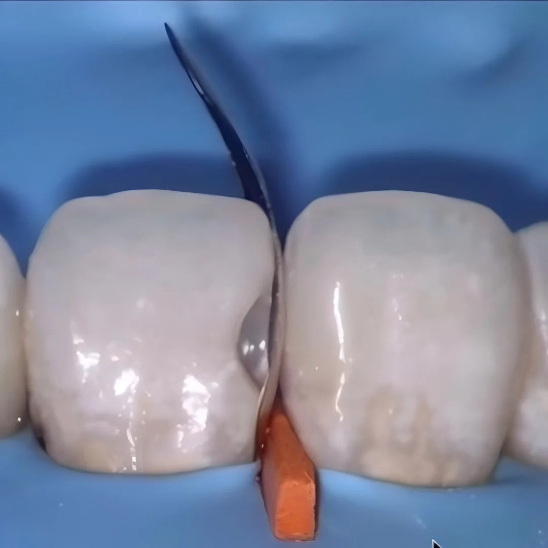 Dentpark Dental Sectional Matrix System Soft Metal Bands M2 1.0 Thickness 0.038MM for class-Ⅱ Composite Resin restoration