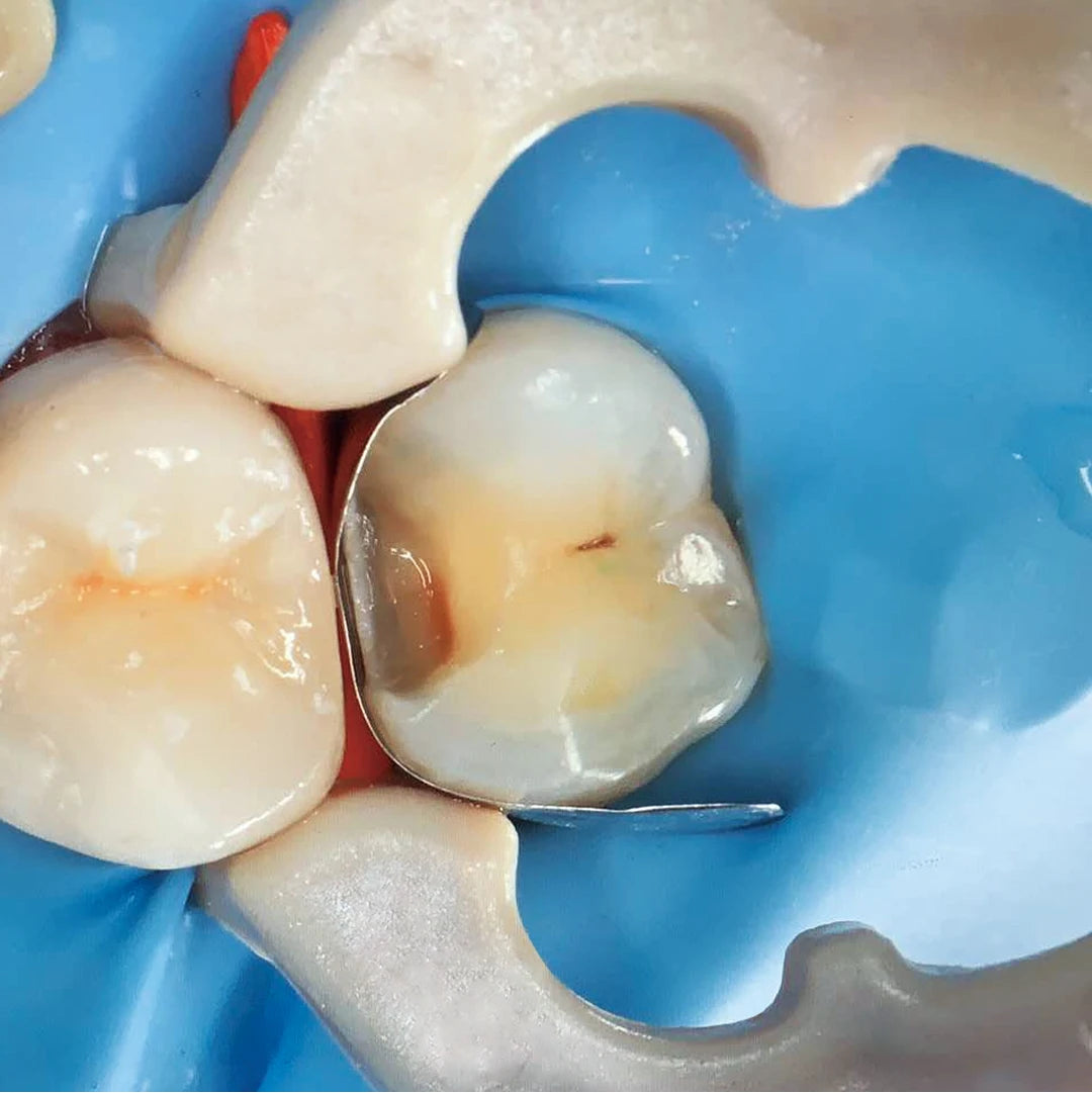 Dentpark Dental Sectional Matrix System Soft Metal Bands M2 1.0 Thickness 0.038MM for class-Ⅱ Composite Resin restoration